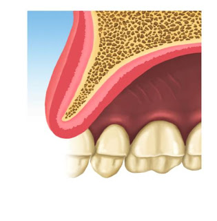 Sección de dentadura con cresta osea atrófica