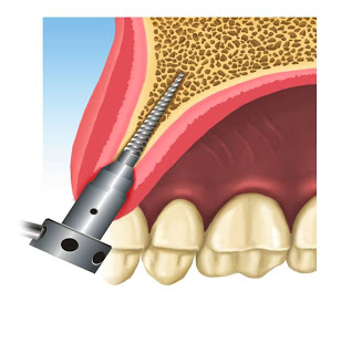 colocación de implante dental pifer expansor