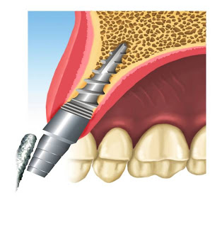 colocación de implante dental pifer