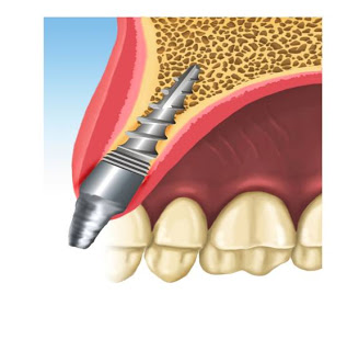 colocación de implante dental pifer, pilar