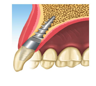 colocación de implante dental pifer - corona provisional