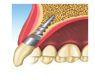 colocación de implante dental pifer - rehabilitación definitiva