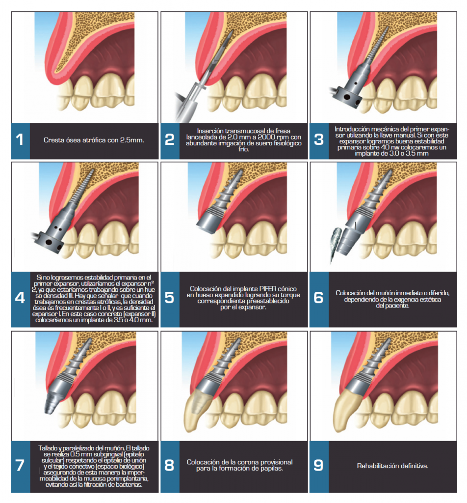 pifer_expansores