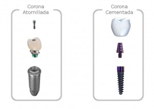 Diferencias entre las coronas dentales cementadas y atornilladas