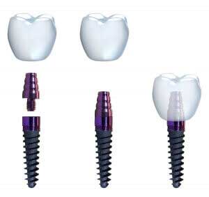 Proceso implantes dentales