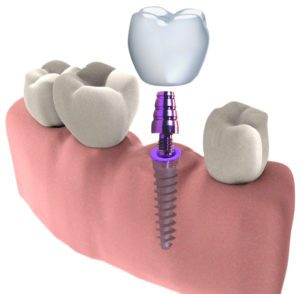 Colocación de un implante dental en 3D