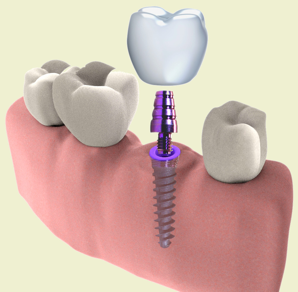 Colocación de un implante dental en 3D con fondo verde